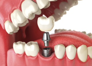 Oral_White_Dra_Lizeth_Duran_odontologia_bogota_Implantes_dentales_bogota